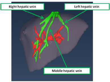 Liver vasculature and segmentation in CT scan – Brian's Radiology 